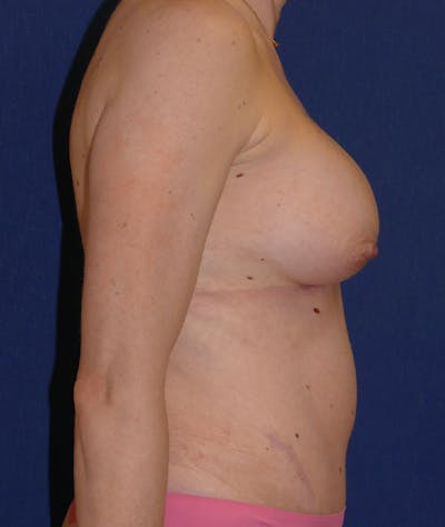 Breast Augmentation Gallery - Patient 118002373 - Image 6