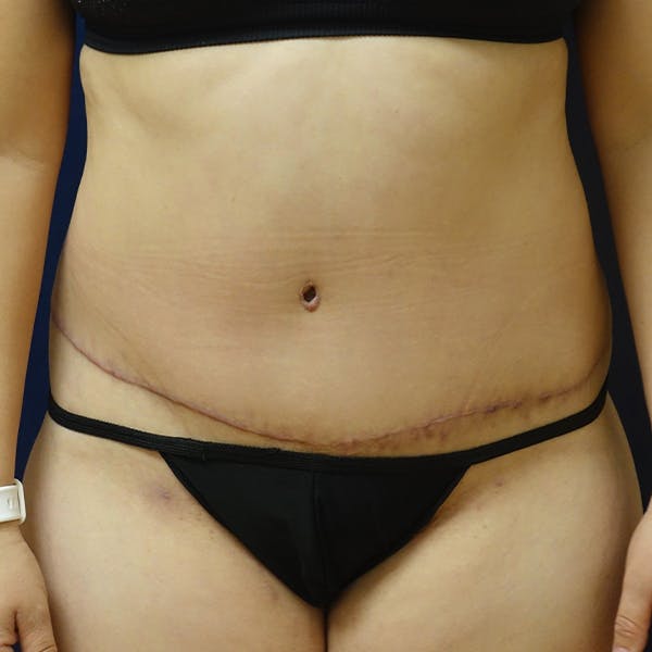 Tummy Tuck (Abdominoplasty) Gallery - Patient 118002789 - Image 2