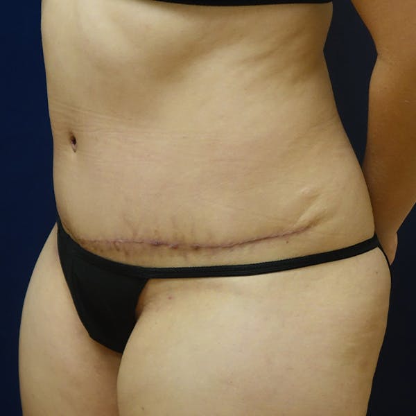Tummy Tuck (Abdominoplasty) Gallery - Patient 118002789 - Image 4