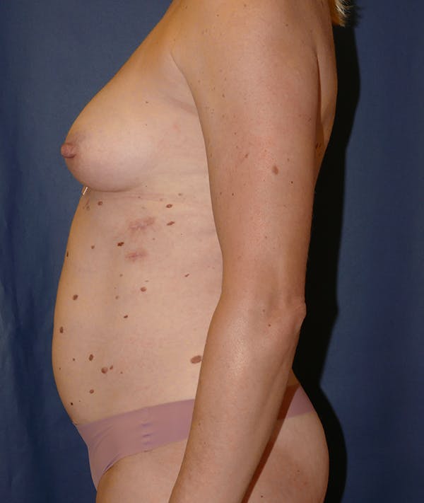 Mommy Makeover Gallery - Patient 118002924 - Image 3