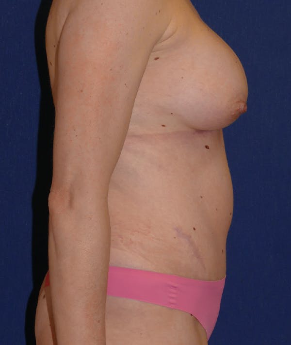 Mommy Makeover Gallery - Patient 118002924 - Image 6