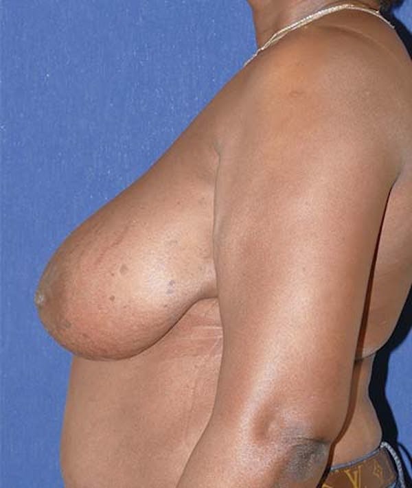 Breast Lift Gallery - Patient 121873328 - Image 9