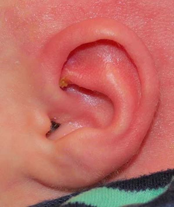 Ear Molding Gallery - Patient 121873813 - Image 2