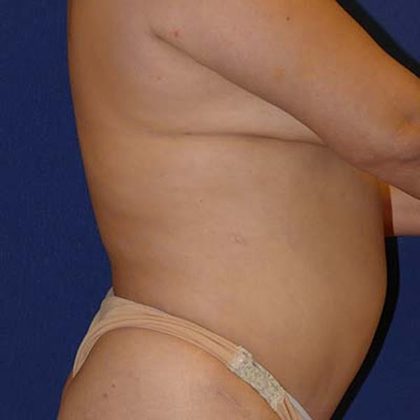 Liposuction Gallery - Patient 121892082 - Image 5