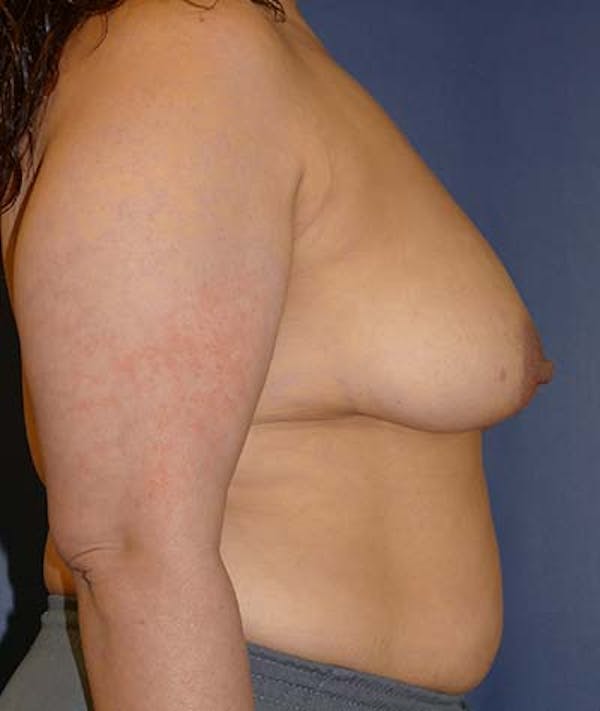 Breast Lift Gallery - Patient 121892390 - Image 5