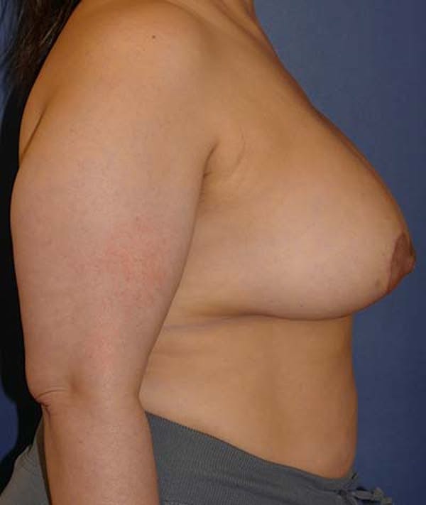 Breast Lift Gallery - Patient 121892390 - Image 6