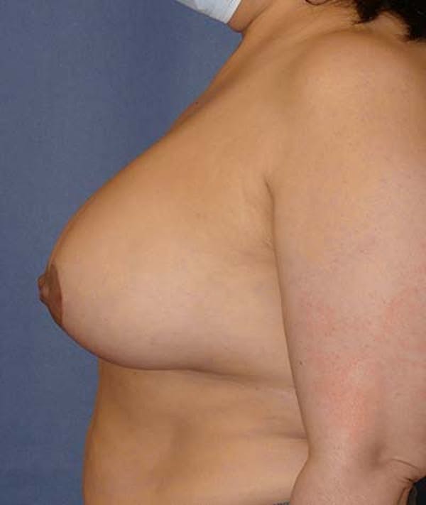 Breast Lift Gallery - Patient 121892390 - Image 10