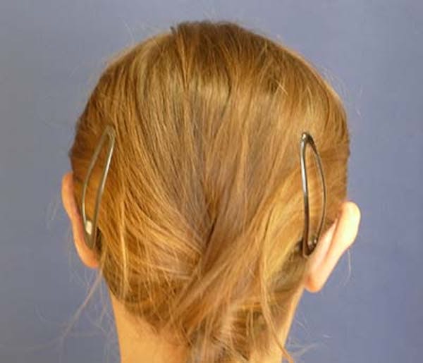 Ear Pinning (Otoplasty) Gallery - Patient 31729526 - Image 6