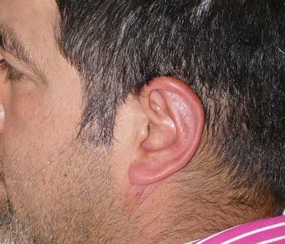 Ear Pinning (Otoplasty) Gallery - Patient 54025817 - Image 8
