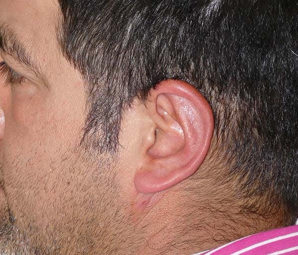 Ear Pinning (Otoplasty) Gallery - Patient 54025817 - Image 8