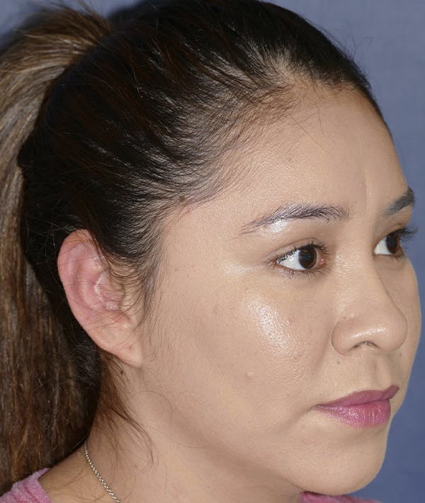 Ear Pinning (Otoplasty) Gallery - Patient 123001182 - Image 4