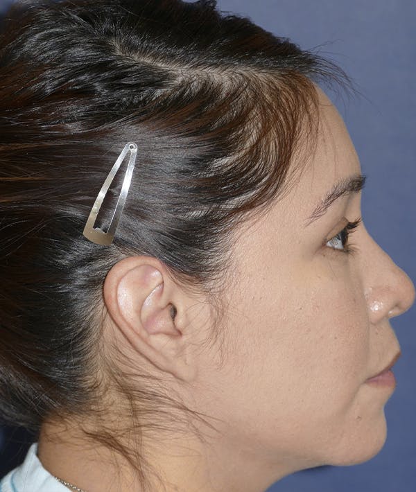Ear Pinning (Otoplasty) Gallery - Patient 123001182 - Image 5