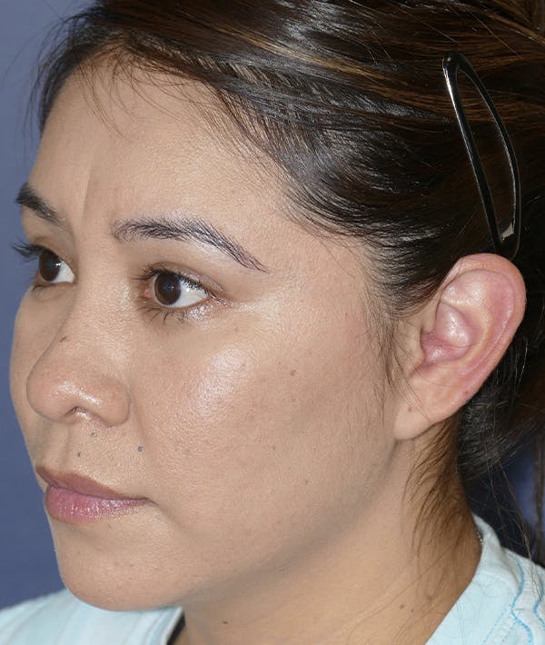 Ear Pinning (Otoplasty) Gallery - Patient 123001182 - Image 9
