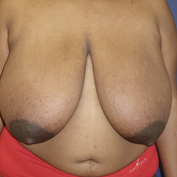 Breast Reduction Gallery - Patient 123001214 - Image 1