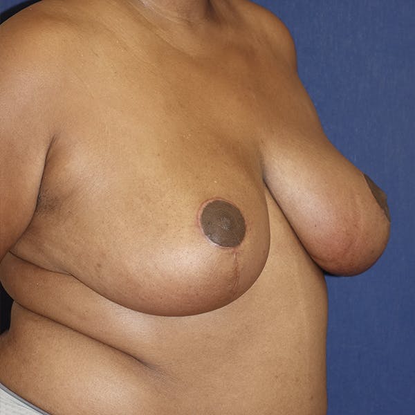 Breast Reduction Gallery - Patient 123001214 - Image 4