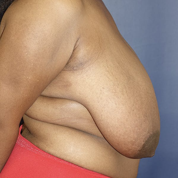 Breast Reduction Gallery - Patient 123001214 - Image 5