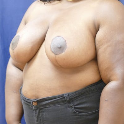 Breast Reduction Gallery - Patient 123001215 - Image 4