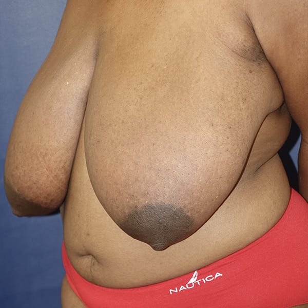 Breast Reduction Gallery - Patient 123001214 - Image 9