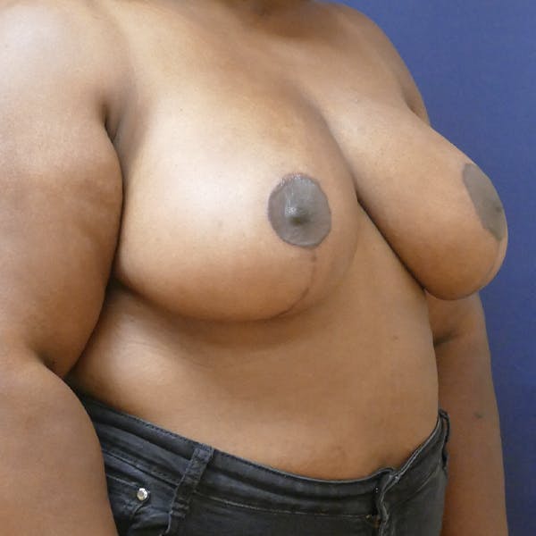 Breast Reduction Gallery - Patient 123001215 - Image 10