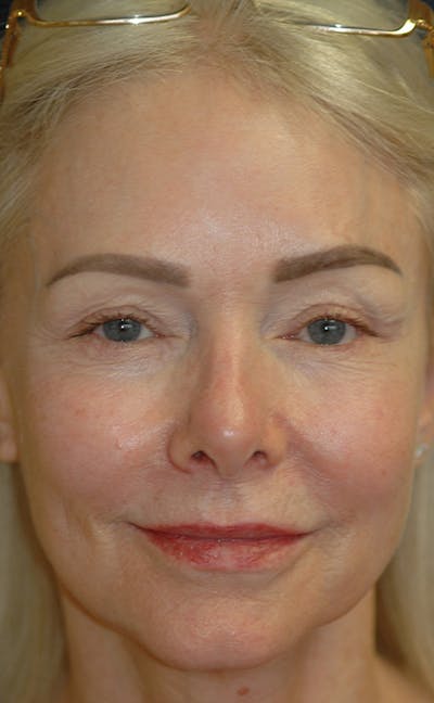 Facelift Gallery - Patient 123001239 - Image 1