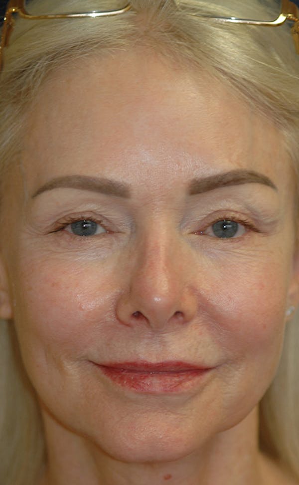 Facelift Gallery - Patient 123001239 - Image 1