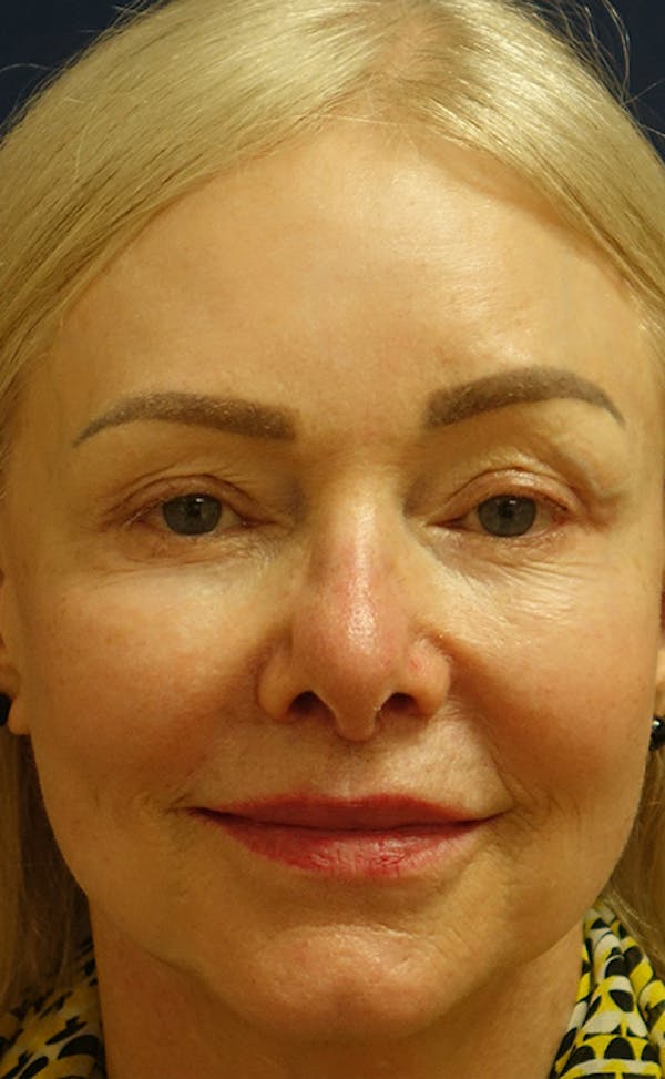 Facelift Gallery - Patient 123001239 - Image 2