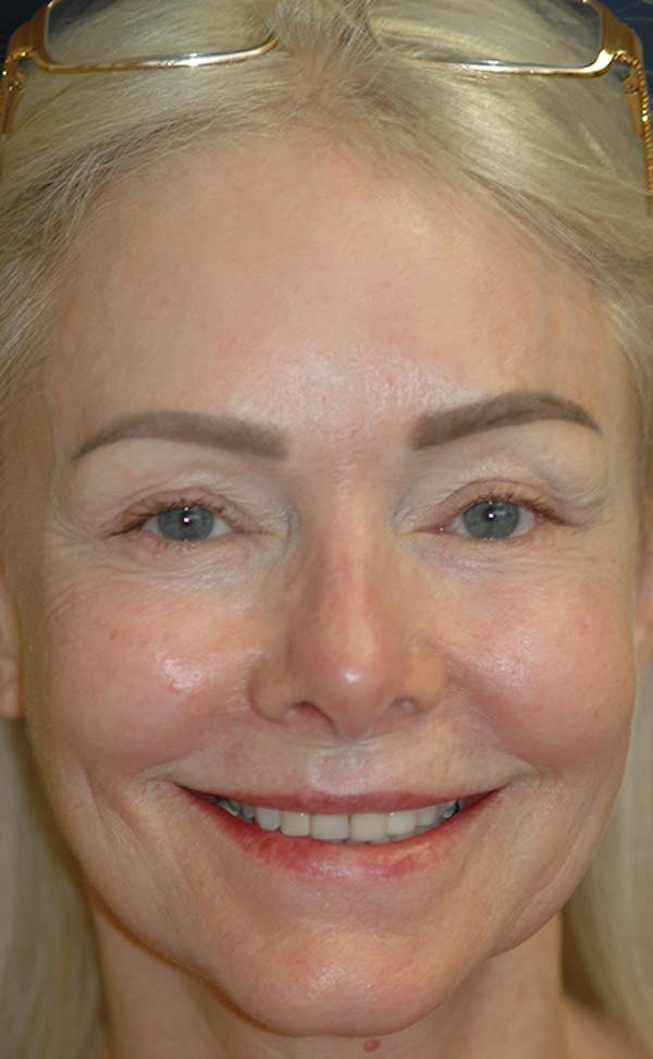 Facelift Gallery - Patient 123001239 - Image 3