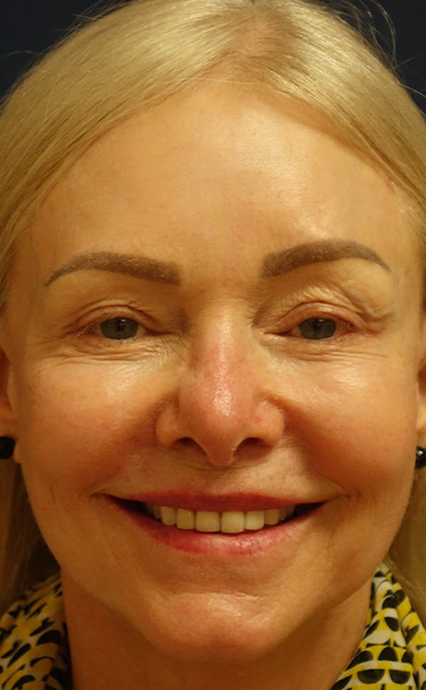 Facelift Gallery - Patient 123001239 - Image 4