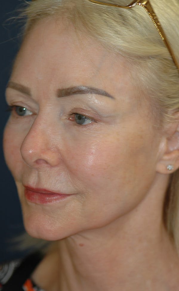 Facelift Gallery - Patient 123001239 - Image 5