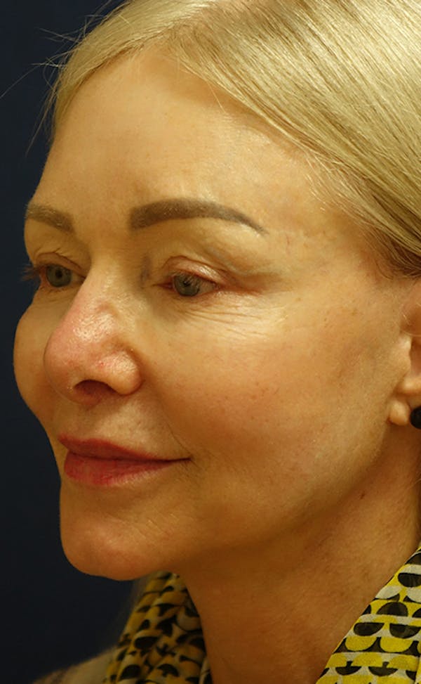 Facelift Gallery - Patient 123001239 - Image 6