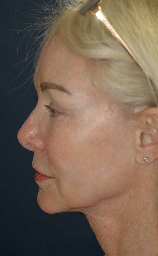 Facelift Gallery - Patient 123001239 - Image 7