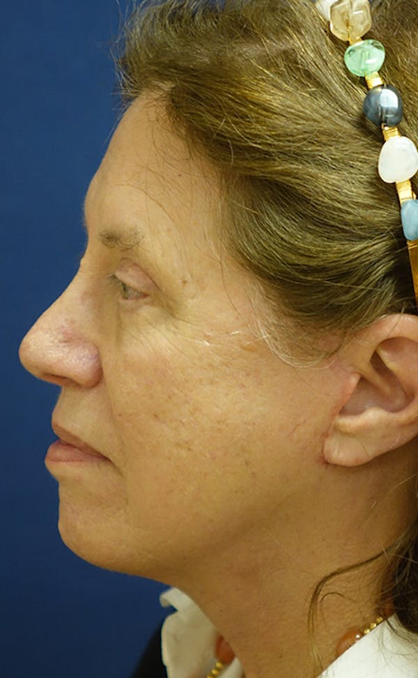 Facelift Gallery - Patient 123001240 - Image 4