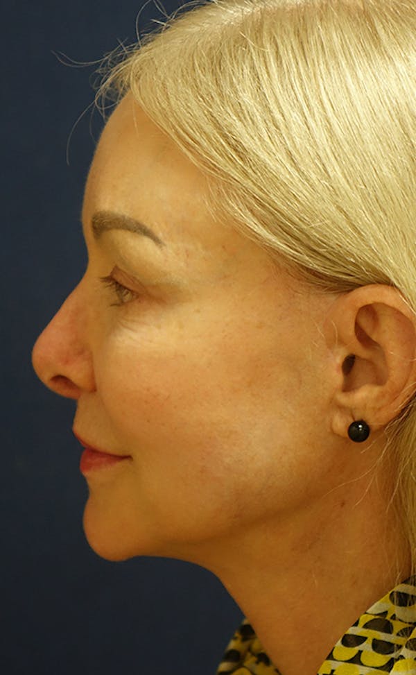 Neck Lift Gallery - Patient 123001241 - Image 8