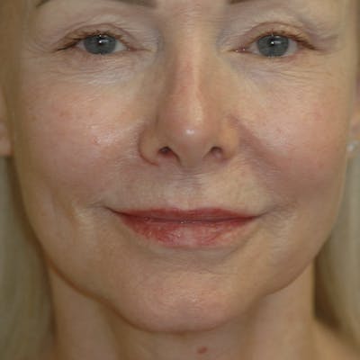 Lip Lift Gallery - Patient 123001248 - Image 1