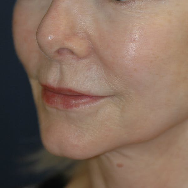 Lip Lift Gallery - Patient 123001248 - Image 5