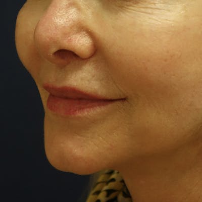 Lip Lift Gallery - Patient 123001248 - Image 6