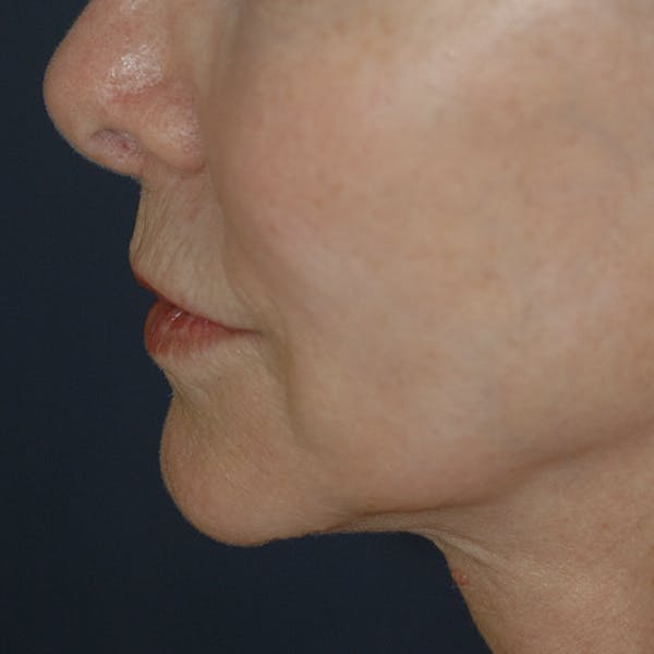 Lip Lift Gallery - Patient 123001248 - Image 7