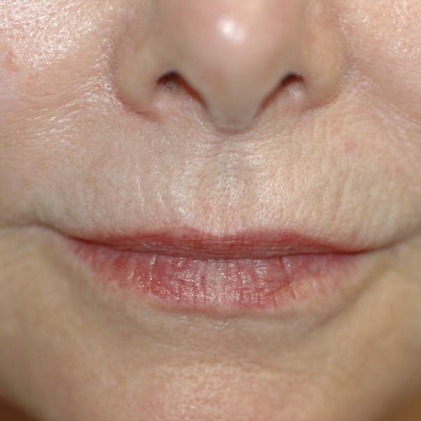 Lip Lift Gallery - Patient 123001248 - Image 9