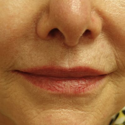 Lip Lift Gallery - Patient 123001248 - Image 10