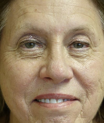 Eyelid Lift (Blepharoplasty) Gallery - Patient 123001269 - Image 1