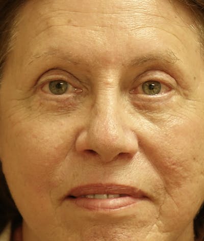 Eyelid Lift (Blepharoplasty) Gallery - Patient 123001269 - Image 2