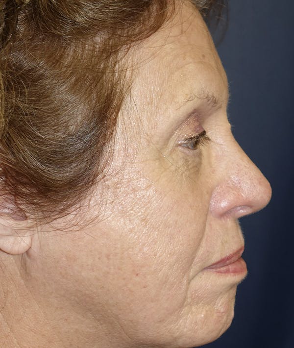 Eyelid Lift (Blepharoplasty) Gallery - Patient 123001269 - Image 5