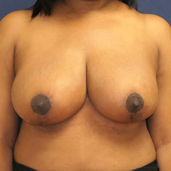 Breast Reduction Gallery - Patient 133257233 - Image 2