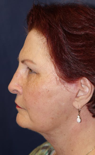 Facelift Gallery - Patient 133257404 - Image 10