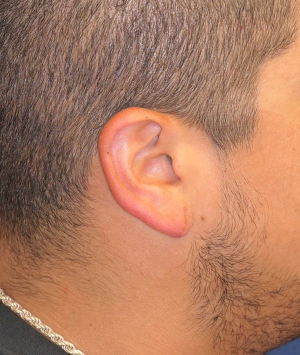 Ear Pinning (Otoplasty) Gallery - Patient 133258787 - Image 4