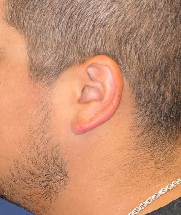 Ear Pinning (Otoplasty) Gallery - Patient 133258787 - Image 6