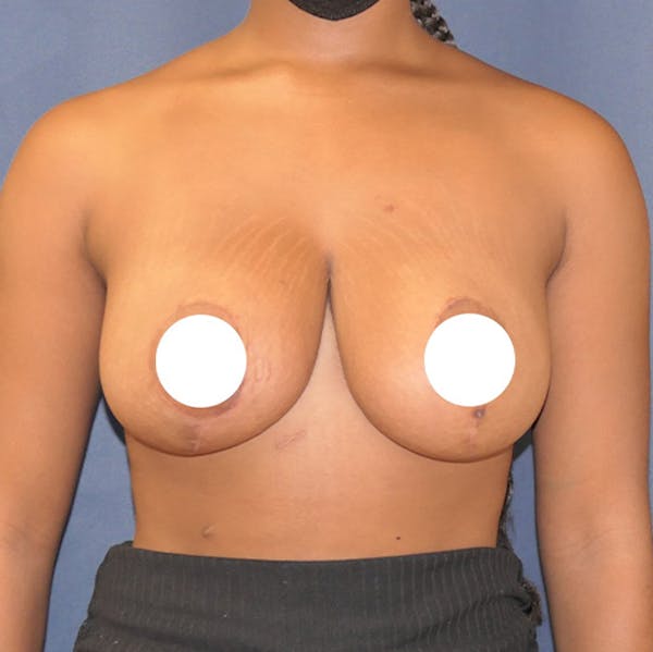 Breast Reduction Gallery - Patient 141725150 - Image 2