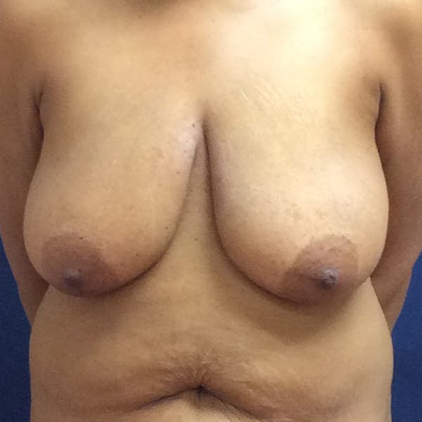 Breast Reduction Gallery - Patient 141725322 - Image 1