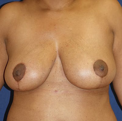 Breast Reduction Gallery - Patient 141725322 - Image 2