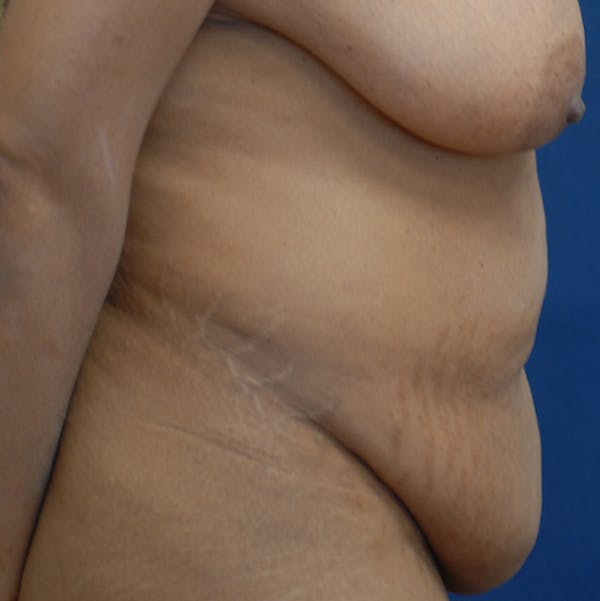 Tummy Tuck (Abdominoplasty) Gallery - Patient 141725961 - Image 9